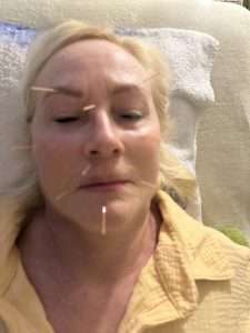 Facelifting mit Akupunktur