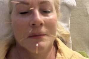 Facelifting mit Akupunktur